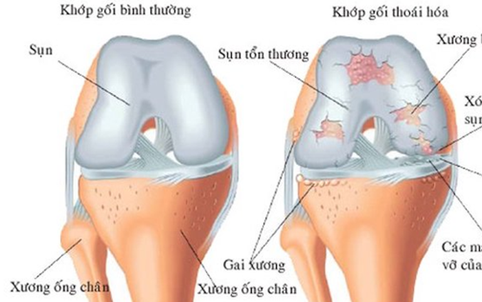 Bài Tập Hiệu Quả Giúp Người Bệnh Thoái Hóa Khớp Gối Cải Thiện Sức Khỏe