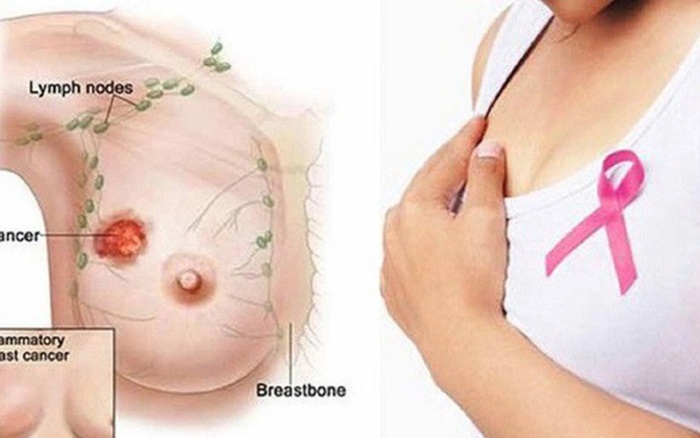 Phát hiện khối u hiếm gặp ở ngực, phụ nữ Hà Nội 38 tuổi đối mặt với nguy cơ tái phát cao